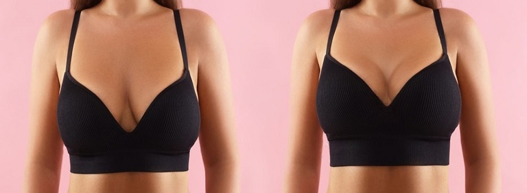 Best Breast Augmentation in Altrincham